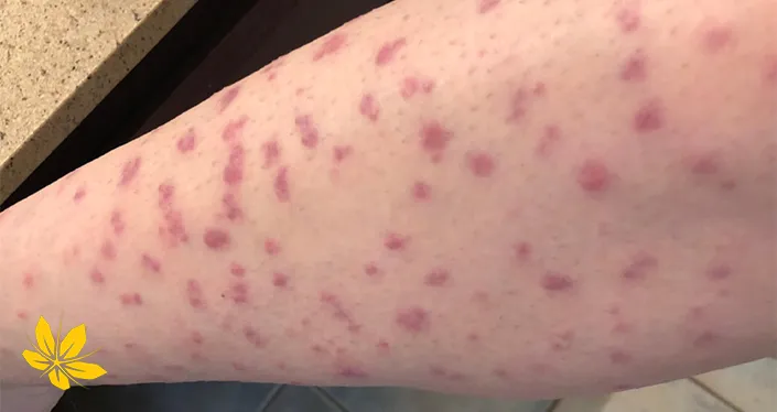 علائم بیماری پتشی petechiae-disease-arm