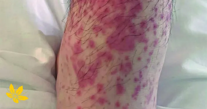 درمان بیماری پتشی petechiae-disease-leg