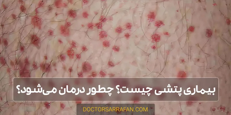 علت پتشی و راه درمان آن-petechiae-disease