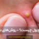 پوسچول چیست؟-pustule-treatment