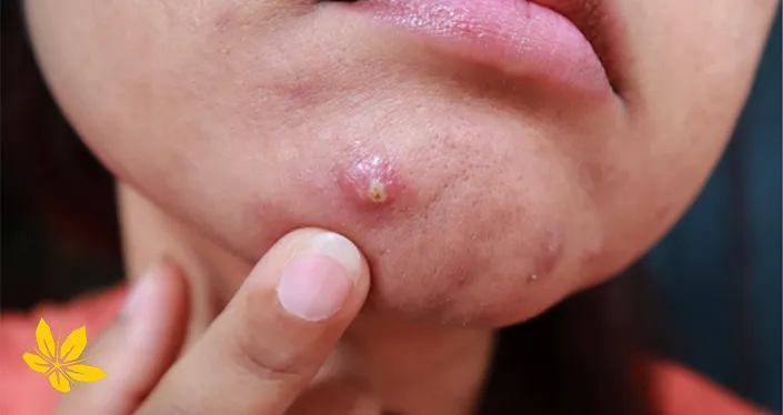 پوسچول صورت-pustule-face