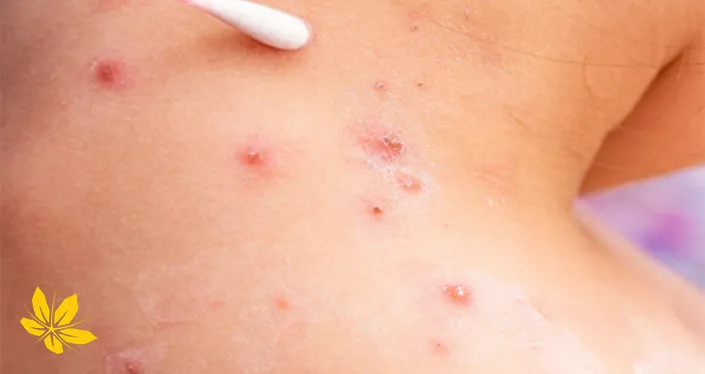 پوسچول شانه-pustule-shoulder