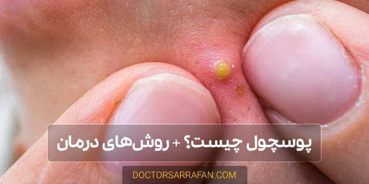 پوسچول چیست؟-pustule-treatment