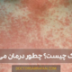 مخملک چیست؟چطور درمان می‌شود؟ scarlet-fever