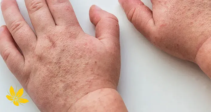 درمان خارش مخملک-scarlet-fever-baby-hand