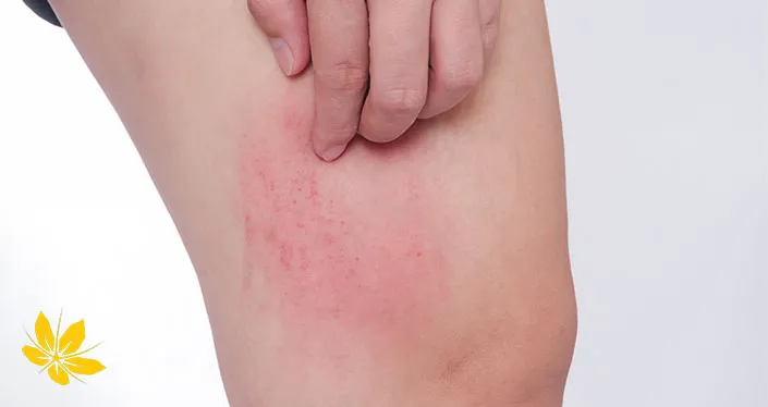 خارش کهیر-urticaria-itching