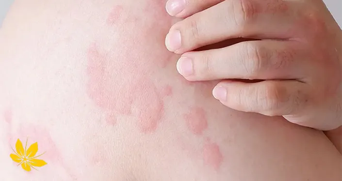 کهیر-urticaria