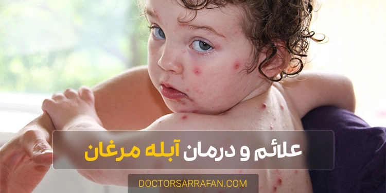 بیماری و درمان آبله مرغان - Chickenpox disease treatment