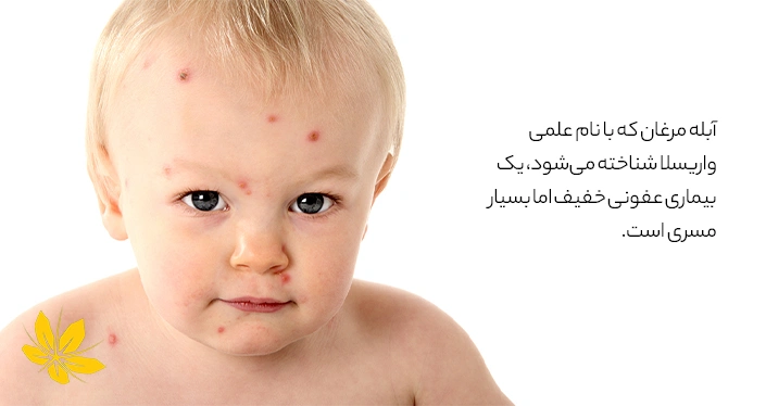 آبله مرغان در کودکان - Chickenpox in children
