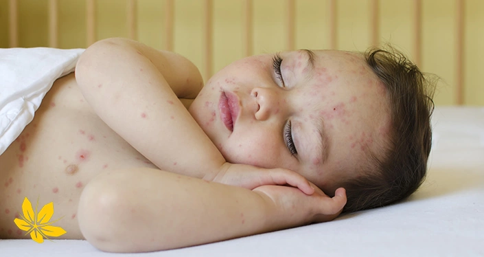 درمان آبله مرغان با استراحت - Chickenpox treatment with rest