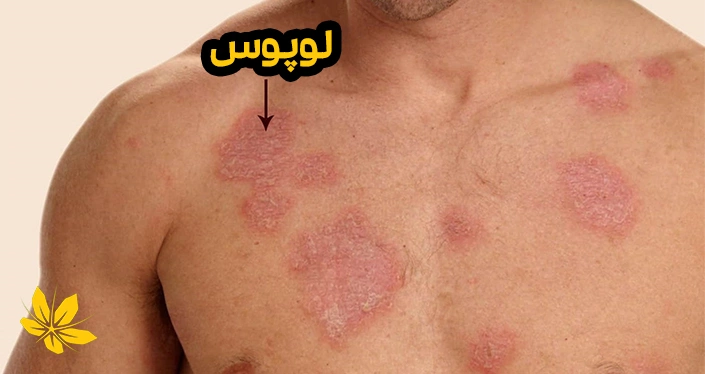 علائم لوپوس - Lupus causes