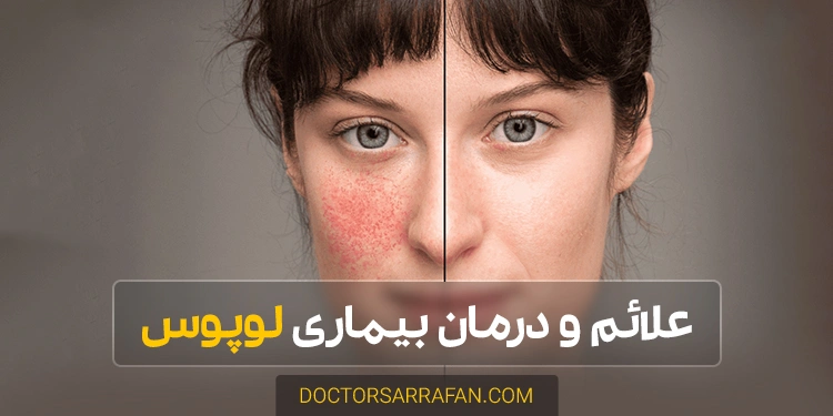بیماری لوپوس - Lupus disease
