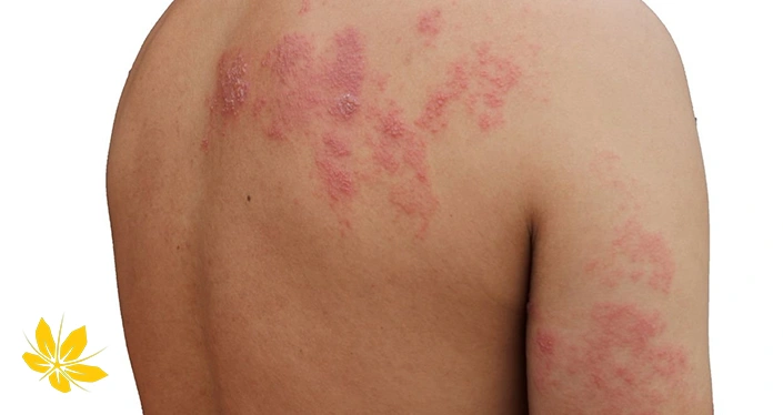 علائم زونا روی بدن مردان - Men Shingles