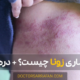 معرفی بیماری و درمان زونا - Shingles and treatment