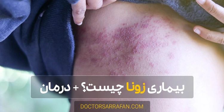 معرفی بیماری و درمان زونا - Shingles and treatment