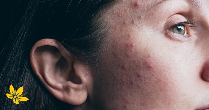 علائم تغییرات هورمونی - Signs of hormonal changes