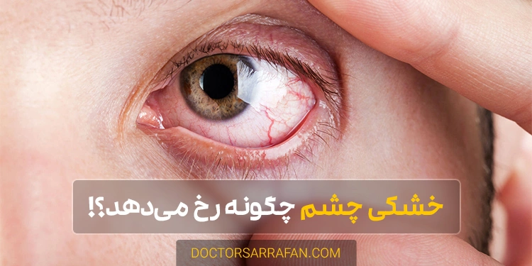 درمان خشکی چشم - Eye dryness treatment