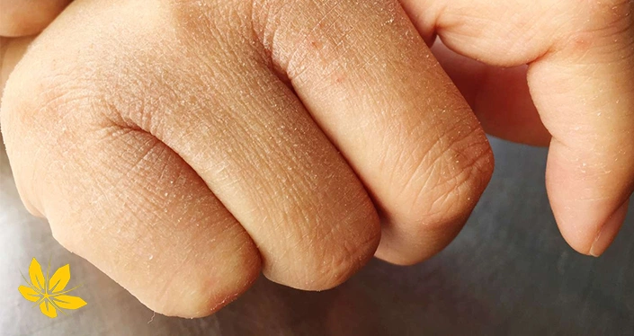 خشکی پوست از علائم بیماری آرتریت روماتوئید - Skin dryness because rheumatoid arthritis disease