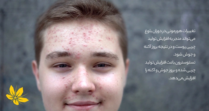 آکنه و جوش پسران در سن بلوغ - Pimples and acne for boys in puberty