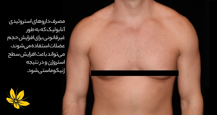 ژنیکوماستی در بدنسازان - Bodybuilders and gynecomastia