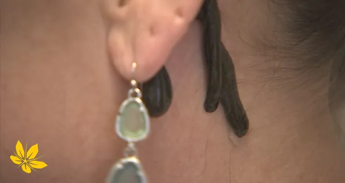 زالو درمانی پشت گوش - Leech therapy and use behind the ear