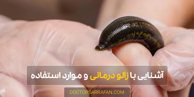 زالو درمانی - Leech therapy