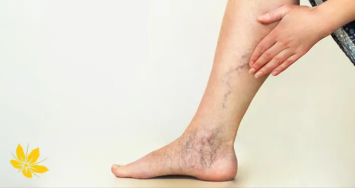زالو درمانی برای واریس - Leeches for the treatment of varicose veins