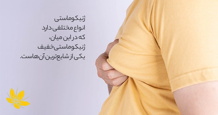 ژنیکوماستی خفیف - Mild gynecomastia