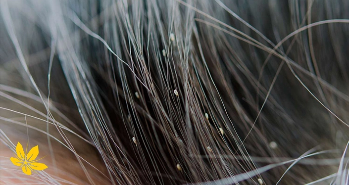 Lice on hair - شپش روی مو