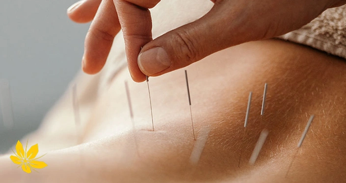 طب سوزنی برای افزایش شانس باردار شدن - Acupuncture to increase chances of getting pregnant