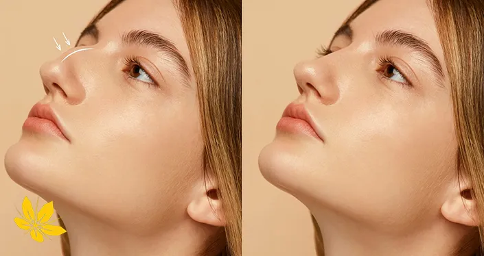 Nasal congestion after nose surgery - گرفتگی بینی بعد از عمل جراحی بینی