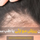 Treatment of hereditary hair loss - درمان ریزش مو ارثی