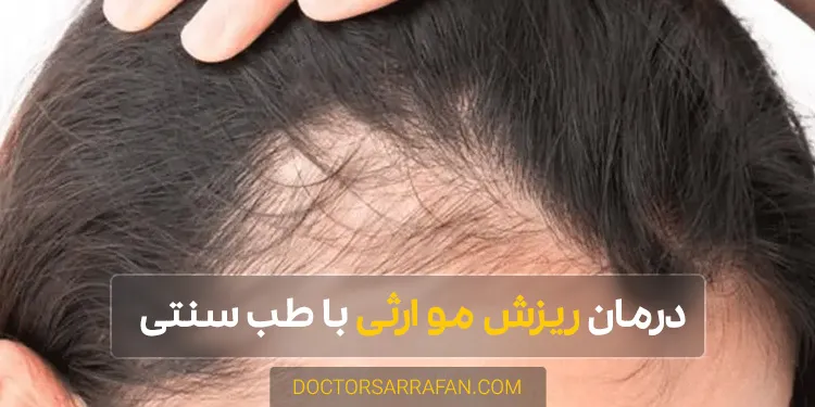 Treatment of hereditary hair loss - درمان ریزش مو ارثی