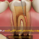 Treatment of root infection of a root canaled tooth - درمان عفونت ریشه دندان عصب کشی شده
