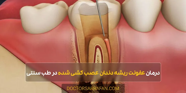 Treatment of root infection of a root canaled tooth - درمان عفونت ریشه دندان عصب کشی شده