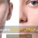 treatment of acne scars - درمان فرورفتگی جای جوش
