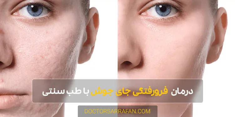 treatment of acne scars - درمان فرورفتگی جای جوش