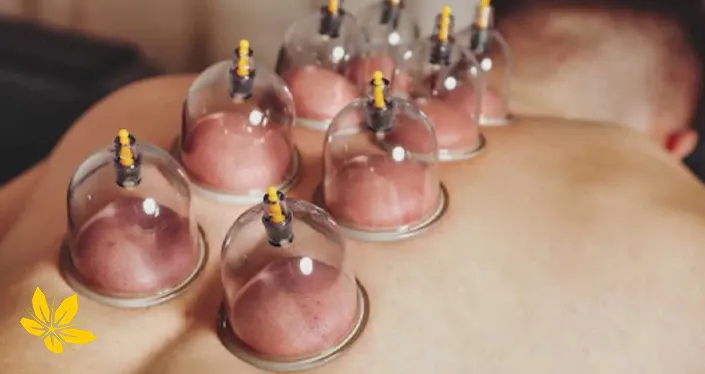 cupping - حجامت