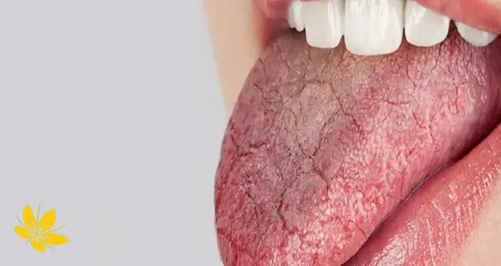 dry mouth - خشکی دهان