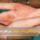 Boiling water burn - سوختگی با آب جوش