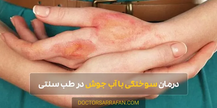 Boiling water burn - سوختگی با آب جوش