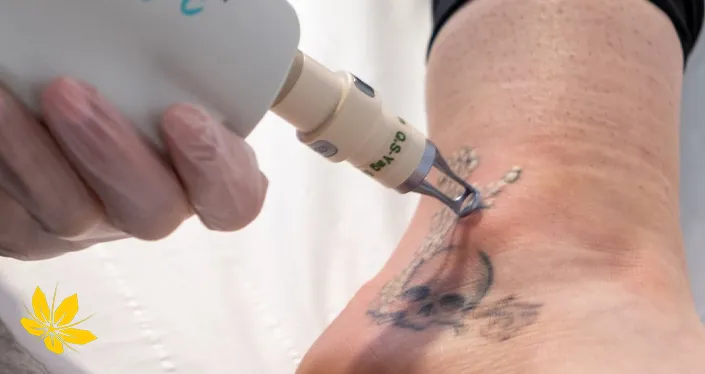 Laser tattoo removal - پاک کردن تاتو با لیزر