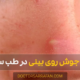 Pimples on the nose - علت جوش روی بینی