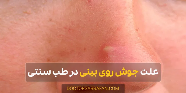 Pimples on the nose - علت جوش روی بینی