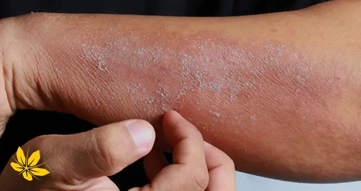 Skin infections - عفونتهای پوستی
