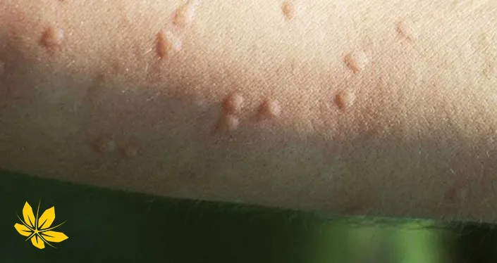 urticaria - کهیر